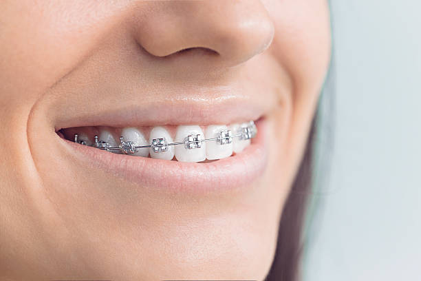 Dental Bonding in Big Pine Key, FL